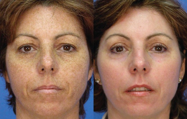 Carboxiterapia - o que é isso em medicina e cosmetologia, avaliações, preço