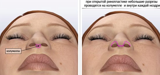 Phương pháp khắc phục sẹo lồi sau nâng mũi