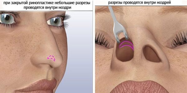 Phương pháp khắc phục sẹo lồi sau nâng mũi