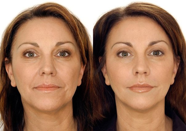 Biorevitalização para o rosto. Técnicas, etapas do curso, características do procedimento