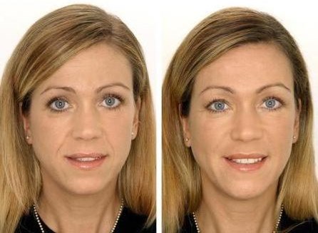 Biorevitalização para o rosto. Técnicas, etapas do curso, características do procedimento