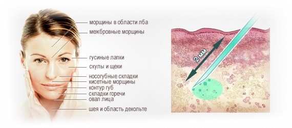 Biorevitalização para o rosto. Técnicas, etapas do curso, características do procedimento