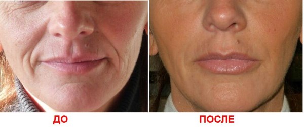Biorevitalização para o rosto. Técnicas, etapas do curso, características do procedimento