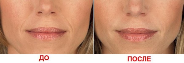 Biorevitalização para o rosto. Técnicas, etapas do curso, características do procedimento