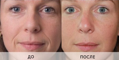 Biorevitalização para o rosto. Técnicas, etapas do curso, características do procedimento