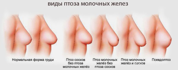 Phẫu thuật thu nhỏ ngực. Ảnh, video, giá cả, đánh giá