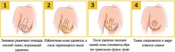 Phẫu thuật thu nhỏ ngực. Ảnh, video, giá cả, đánh giá