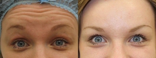Relatox atau Botox - yang mana lebih baik? Perbandingan suntikan untuk suntikan kecantikan