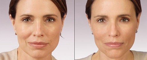 Relatox atau Botox - yang mana lebih baik? Perbandingan Suntikan Kecantikan