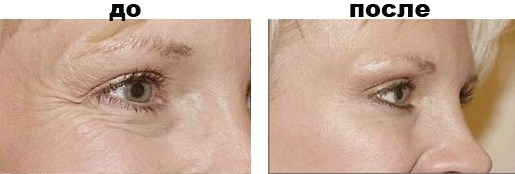 Relatox atau Botox - yang mana lebih baik? Perbandingan Suntikan Kecantikan