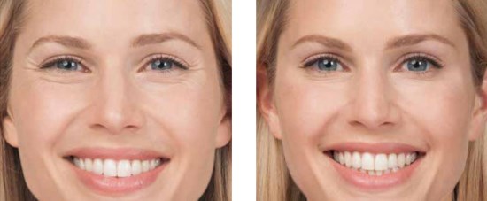 Relatox atau Botox - yang mana lebih baik? Perbandingan Suntikan Suntikan Kecantikan