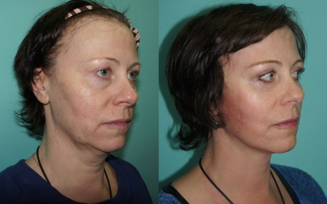 Tiêm axit hyaluronic cho mặt (môi, dưới mắt, trán). Ảnh trước và sau