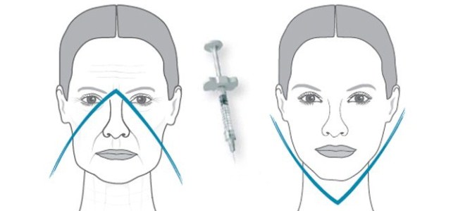 Tiêm axit hyaluronic cho mặt (môi, dưới mắt, trán). Ảnh trước và sau