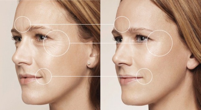 Tiêm axit hyaluronic cho mặt (môi, dưới mắt, trán). Ảnh trước và sau
