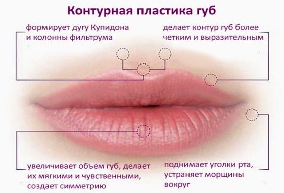 Tiêm axit hyaluronic cho mặt (môi, dưới mắt, trán). Ảnh trước và sau