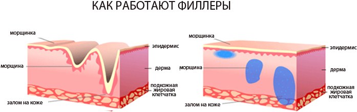 Tiêm axit hyaluronic cho mặt (môi, dưới mắt, trán). Ảnh trước và sau