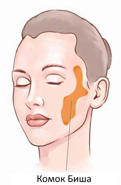 Lũ Bisha. Nó là gì, làm thế nào để loại bỏ nó, một hoạt động, làm thế nào để làm sạch nó tại nhà