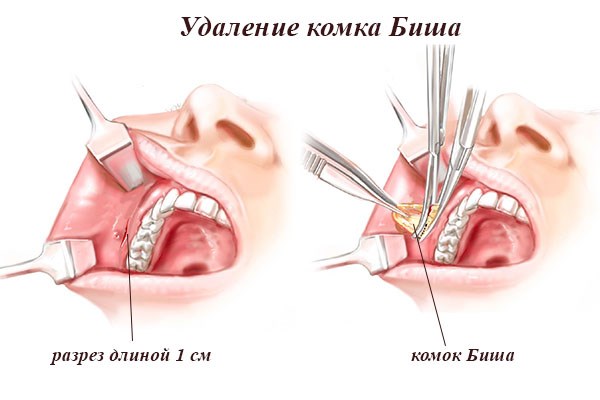 Lũ Bisha. Nó là gì, làm thế nào để loại bỏ nó, một hoạt động, làm thế nào để làm sạch nó tại nhà