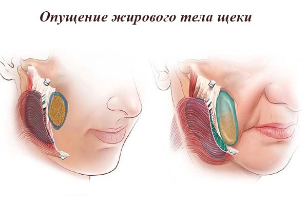 Lũ Bisha. Nó là gì, làm thế nào để loại bỏ nó, một hoạt động, làm thế nào để làm sạch nó tại nhà