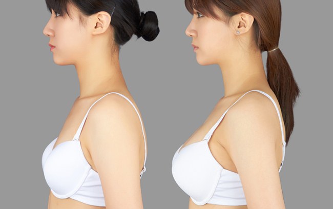 Mammoplasty - การผ่าตัดนี้คืออะไรก่อนและหลังภาพถ่ายพร้อมคำอธิบายบทวิจารณ์