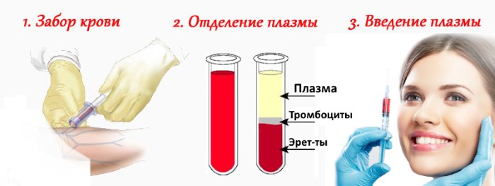 Плазмолифтинг лица. Шта је то, прегледи, како се спроводи, фазе, фотографије пре, после