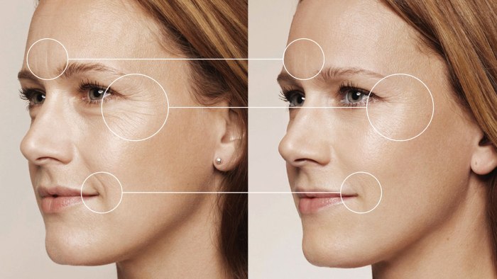 La biorrevitalización es un procedimiento de rejuvenecimiento facial. Preparaciones, precio, reseñas, fotos antes y después