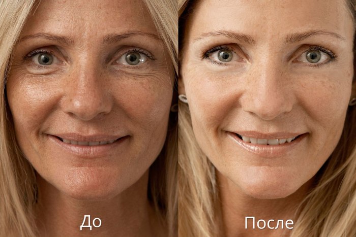 La biorrevitalización es un procedimiento de rejuvenecimiento facial. Preparaciones, precio, reseñas, fotos antes y después