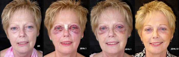 La biorrevitalización es un procedimiento de rejuvenecimiento facial. Preparaciones, precio, reseñas, fotos antes y después