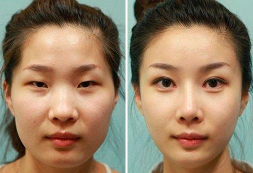 Blepharoplasty - nó là gì, nó diễn ra như thế nào, trước và sau khi chụp ảnh