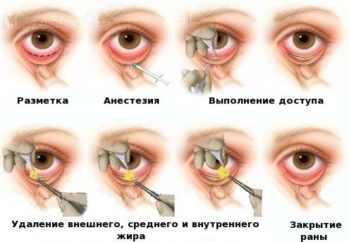 Blepharoplasty - nó là gì, nó diễn ra như thế nào, trước và sau khi chụp ảnh