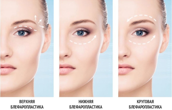 Blepharoplasty - nó là gì, nó diễn ra như thế nào, trước và sau khi chụp ảnh