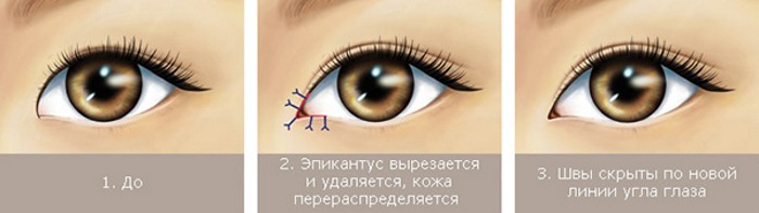 Blepharoplasty - nó là gì, nó diễn ra như thế nào, trước và sau khi chụp ảnh