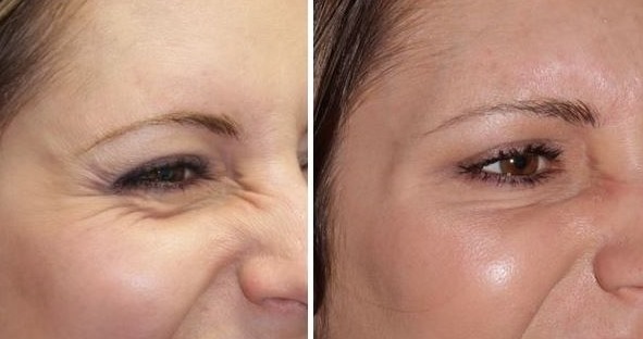 Dysport: qué es, el procedimiento, inyecciones en la frente, entre las cejas de las arrugas. Resultados, foto