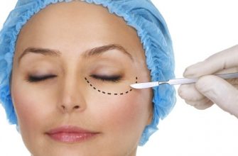 Cantoplasty - apa itu, harga sebelum dan selepas gambar, harga. Pembedahan luar, medial