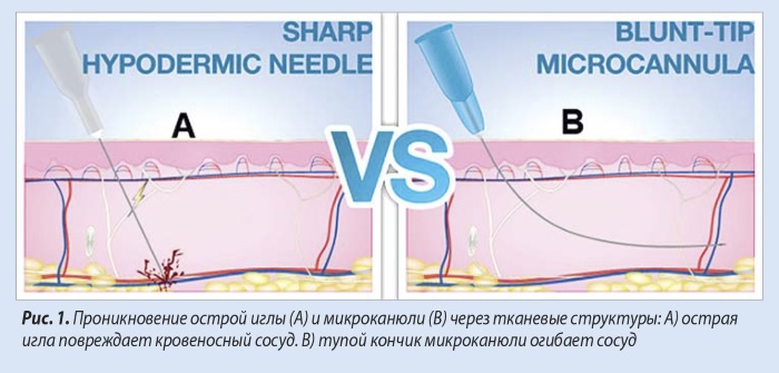 Cannula trong thẩm mỹ và y học