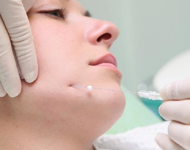 Cannula trong thẩm mỹ và y học
