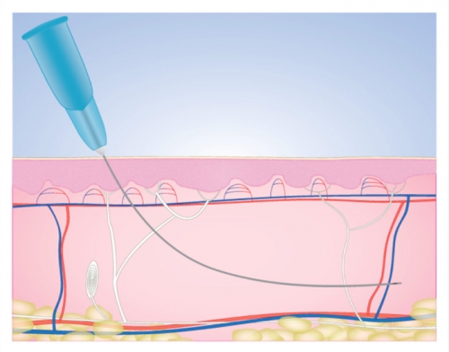 Cannula trong thẩm mỹ và y học