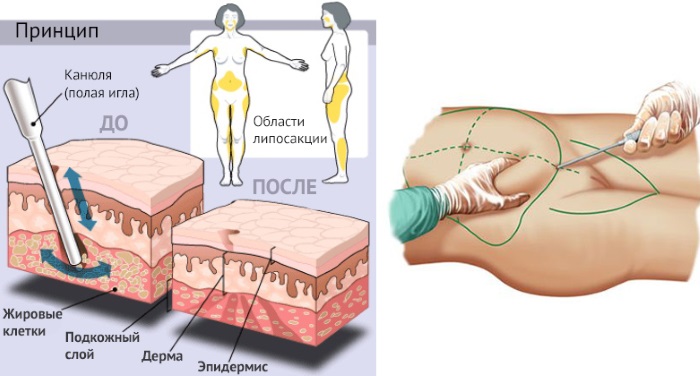 Cannula trong thẩm mỹ và y học