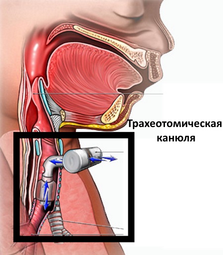 Cannula trong thẩm mỹ và y học
