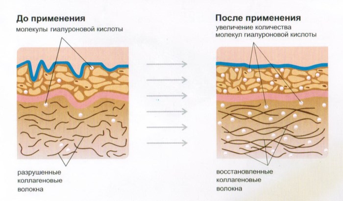 ฟิลเลอร์ครีม - มันคืออะไรวิธีการใช้ฟิลเลอร์ Libriderm สำหรับริ้วรอยลึก บทวิจารณ์