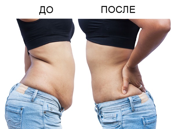 Hút mỡ bụng - các loại, ảnh trước và sau, đánh giá