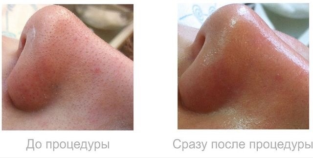 Làm sạch mặt cơ học: siêu âm, thủ công, phần cứng