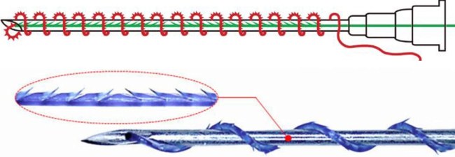 Mesothreads - nâng cơ mặt trong thẩm mỹ. Hình ảnh, đánh giá, giá cả