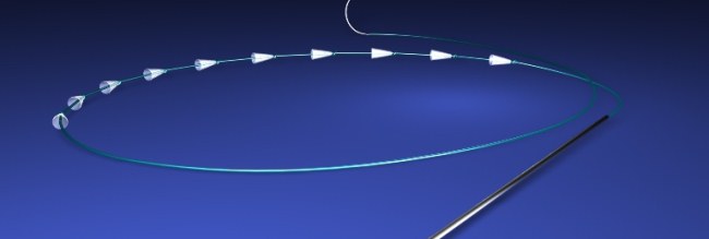 Mesothreads - nâng cơ mặt trong thẩm mỹ. Hình ảnh, đánh giá, giá cả