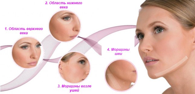 Mesothreads - nâng cơ mặt trong thẩm mỹ. Hình ảnh, đánh giá, giá cả