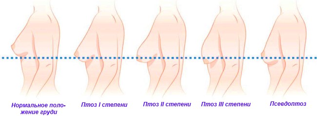 Mesothreads - nâng cơ mặt trong thẩm mỹ. Hình ảnh, đánh giá, giá cả