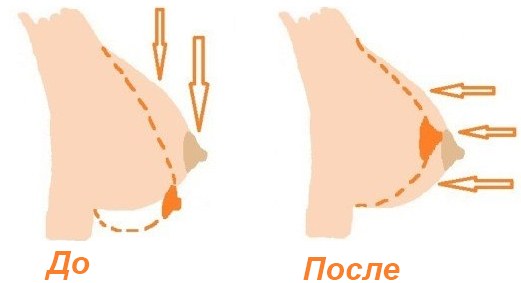Mesothreads - nâng cơ mặt trong thẩm mỹ.Hình ảnh, đánh giá, giá cả