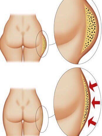 ห่อน้ำผึ้งลดความอ้วนจากเซลลูไลท์ที่บ้าน สูตรอาหารบทวิจารณ์