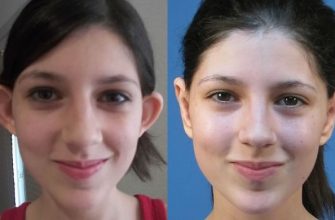 Otoplasty ของหูที่ยื่นออกมา