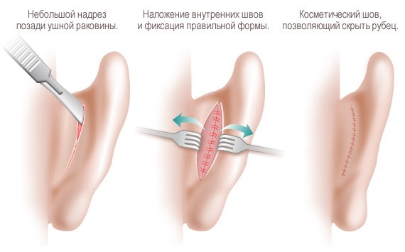 Otoplasty ทำได้อย่างไร